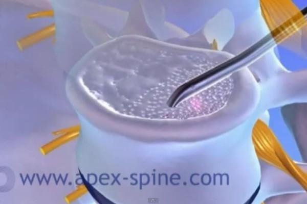 Endoskopische Anfrischung Apex