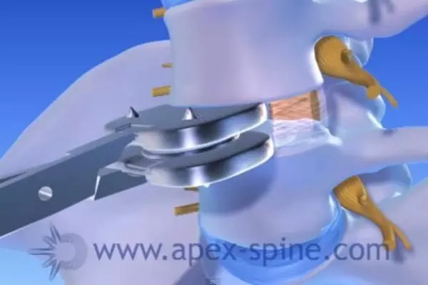 Bandscheibenprothese Hws Apex