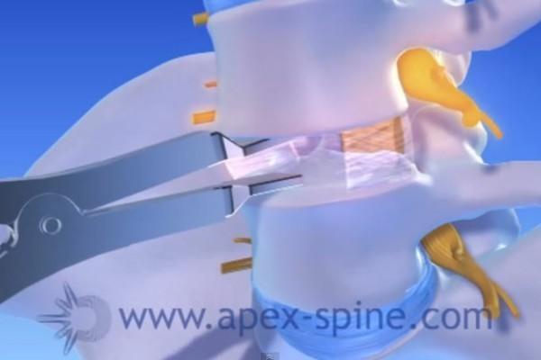 Bandscheibenprothese Apex