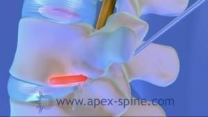 endoskopische-bandscheibenoperation-spinalstenose