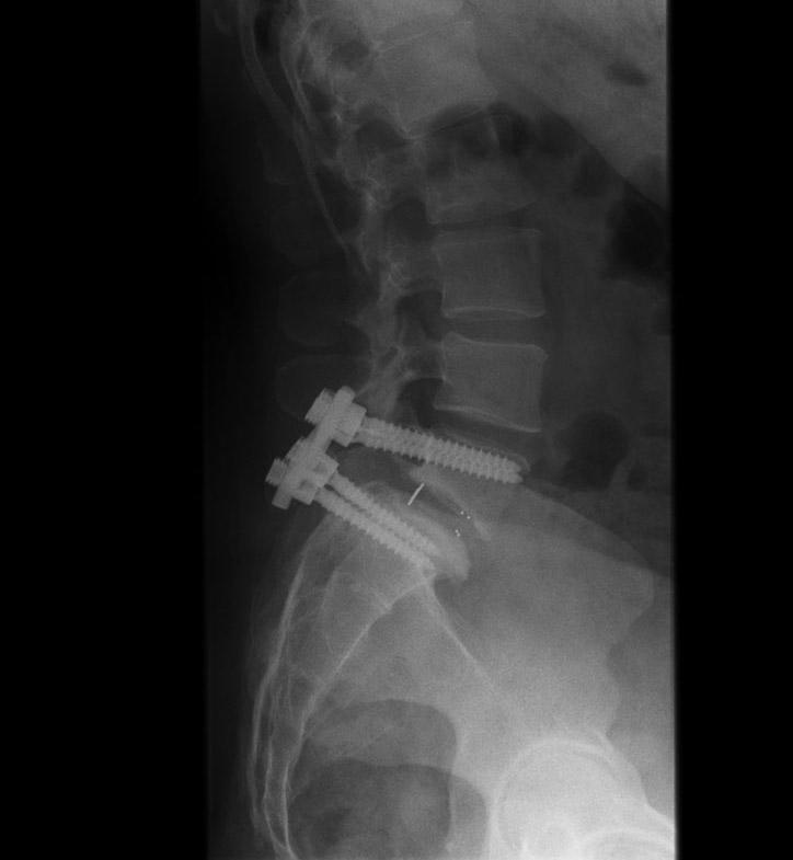 screw vertebral body