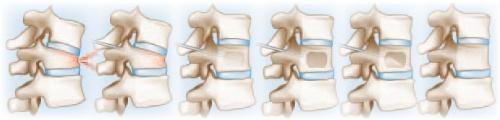 vertebral fractures