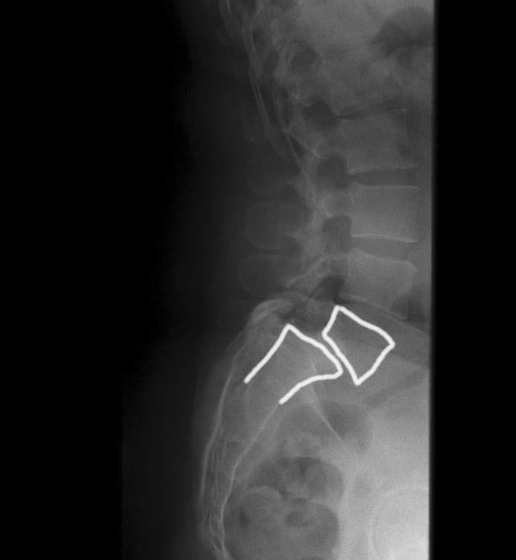 vertebrale glijdende röntgenfoto